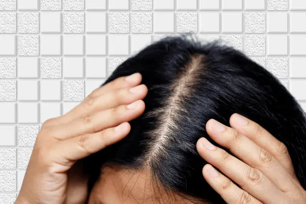 dermatitis seborreica